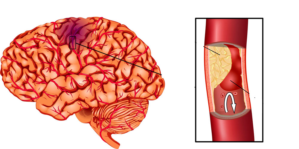 Дистония сосудов головного мозга и как ее лечить