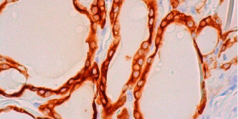 антитела к тиреопероксидазе