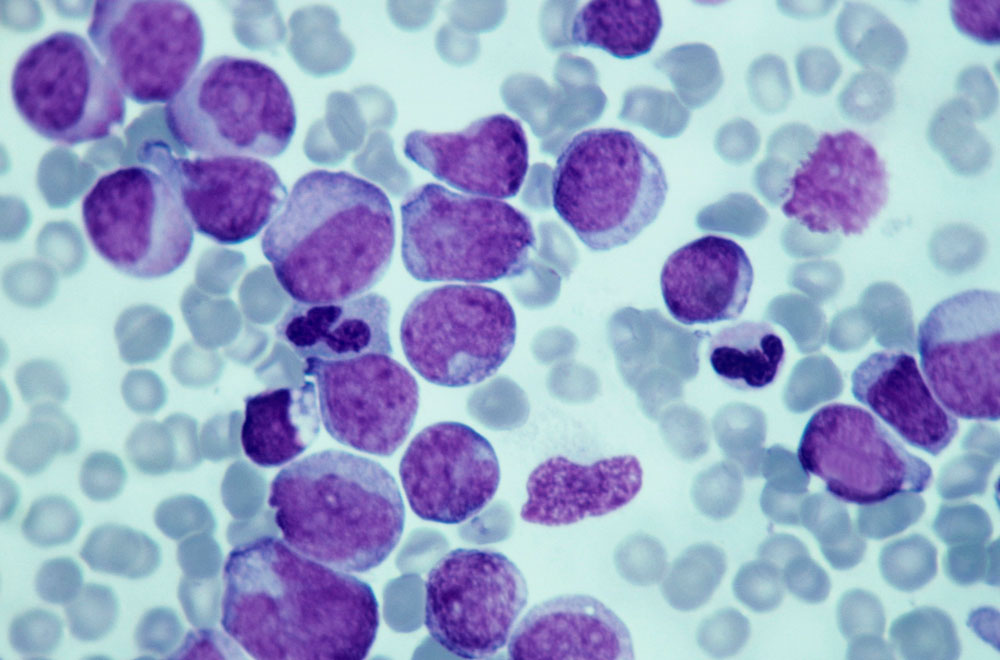 Показатели анализа крови при лейкозе: как определить лейкоз по анализу